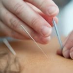 Coronary Heart Diseases and Stroke: Can Acupuncture help with prevention and recovery?